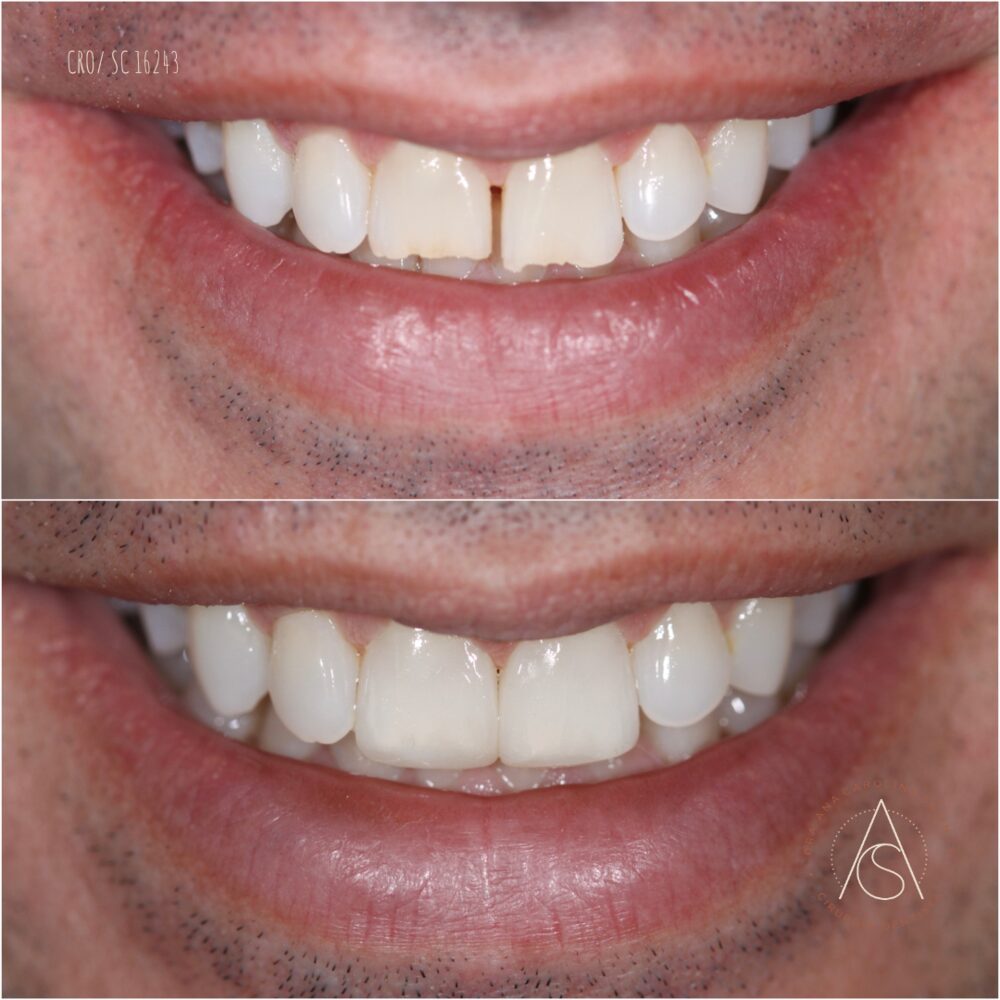 Antes e depois de restauração estética em dente frontal