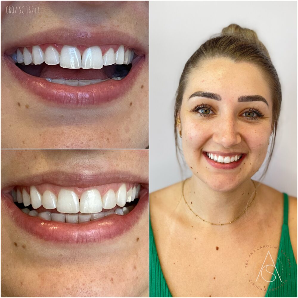 Antes e depois de lentes de contato dental, com retrato da paciente sorrindo