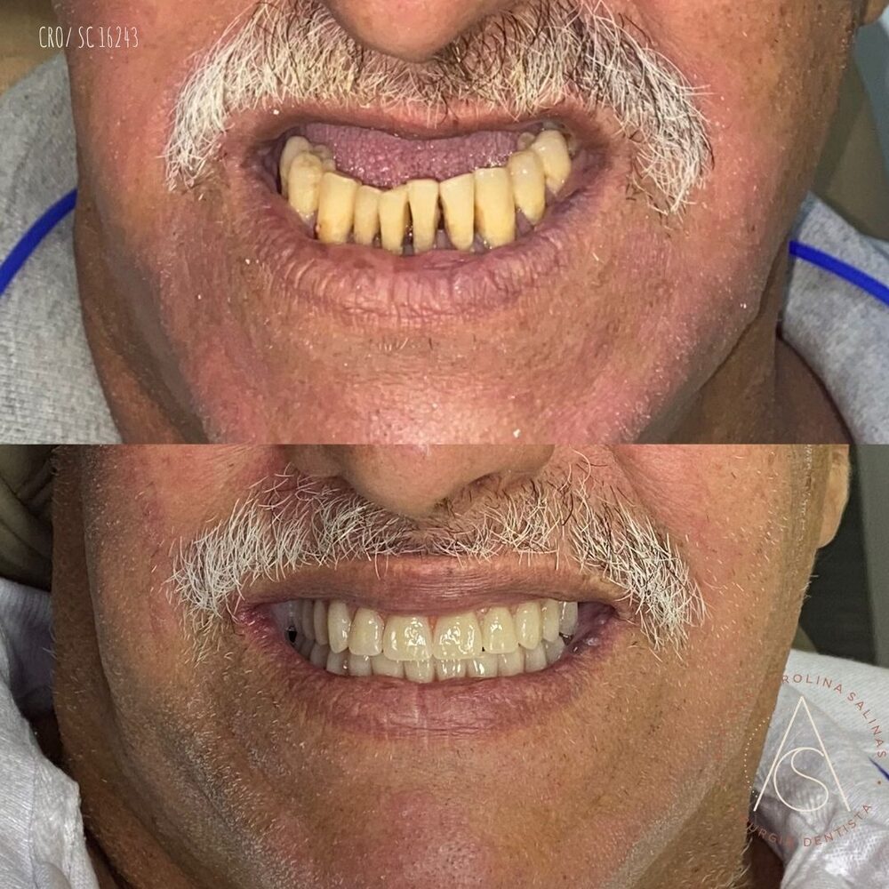 Antes e depois de prótese dentária completa