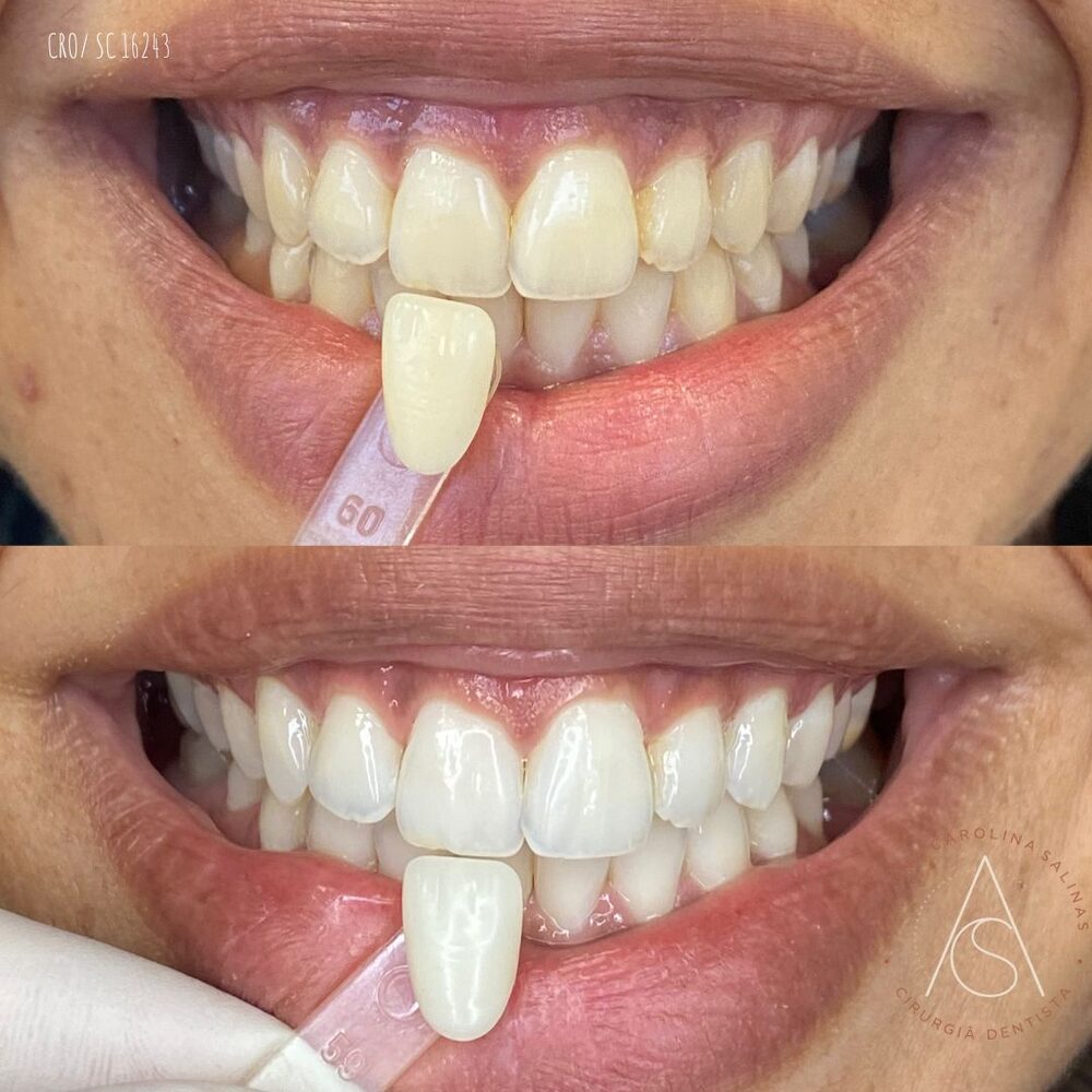 Antes e depois de clareamento dental com escala de cor