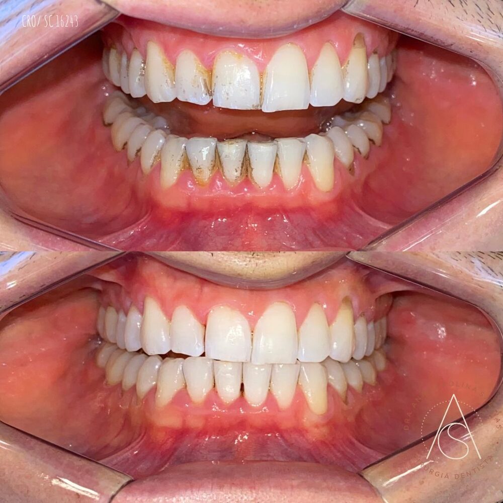 Antes e depois de reabilitação oral completa