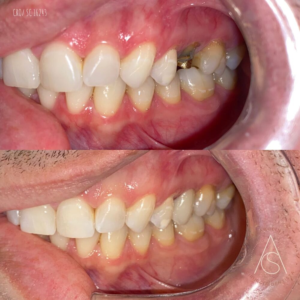 Antes e depois de tratamento odontológico, vista lateral
