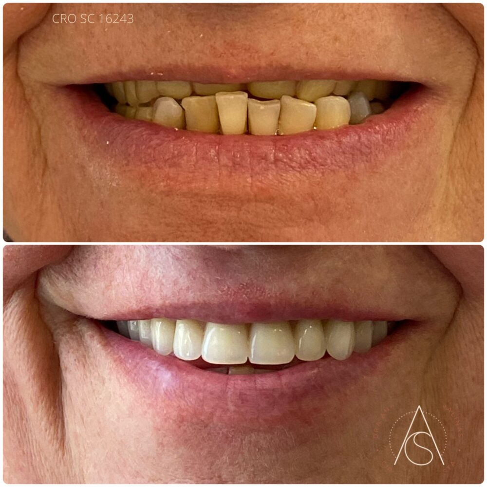 Antes e depois de coroas dentárias em dentes frontais